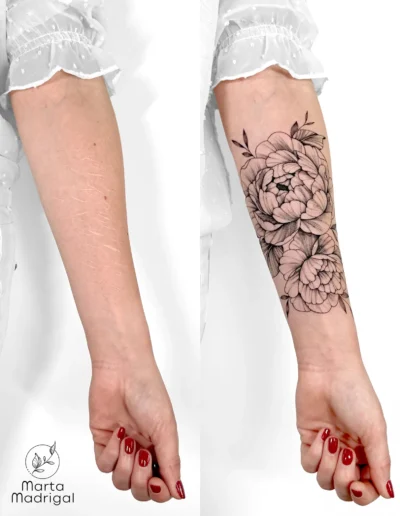 Tatouage pivoines en couverture de cicatrices sur l'avant-bras, a Toulouse