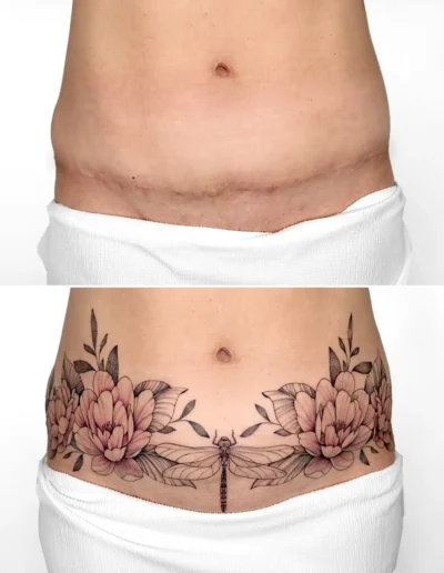 Tatouage pivoines et libellule en couverture de cicatrice de cesarienne sur le ventre, a Toulouse